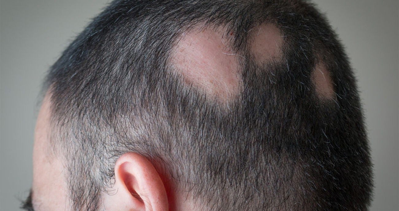 Alopecia Areata Treatment