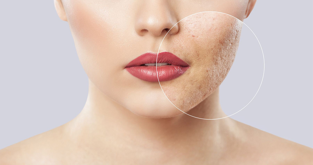 Acne Scar Treatment
