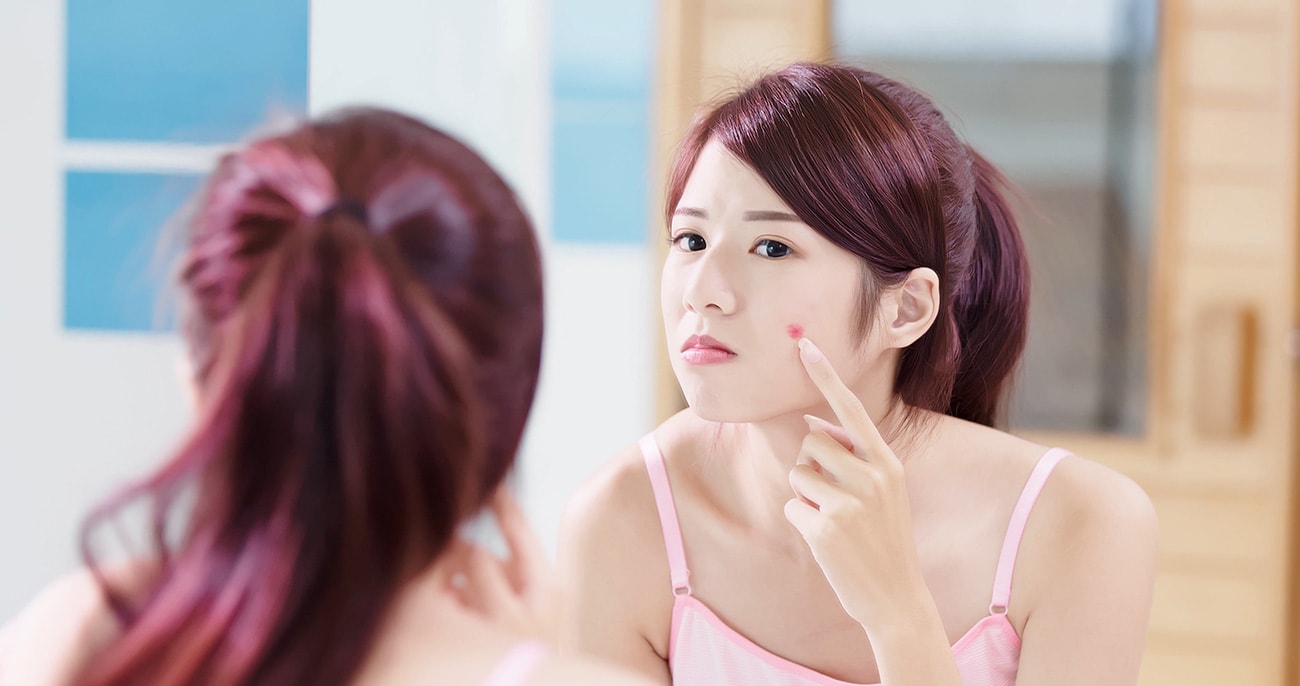 Acne Treatment