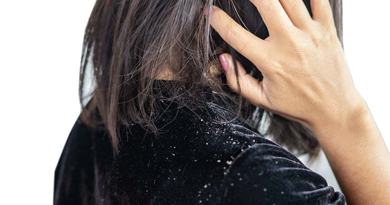 Dandruff Treatment