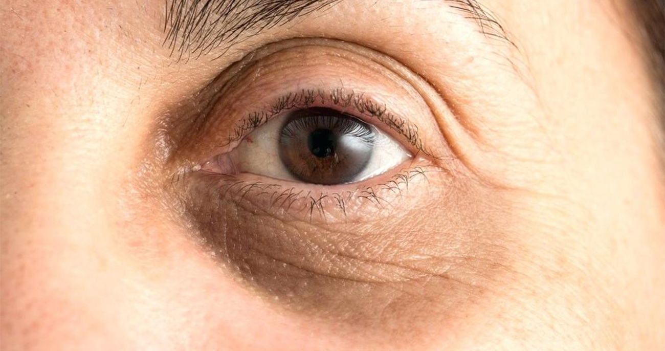 Dark Eye Circles Treatment
