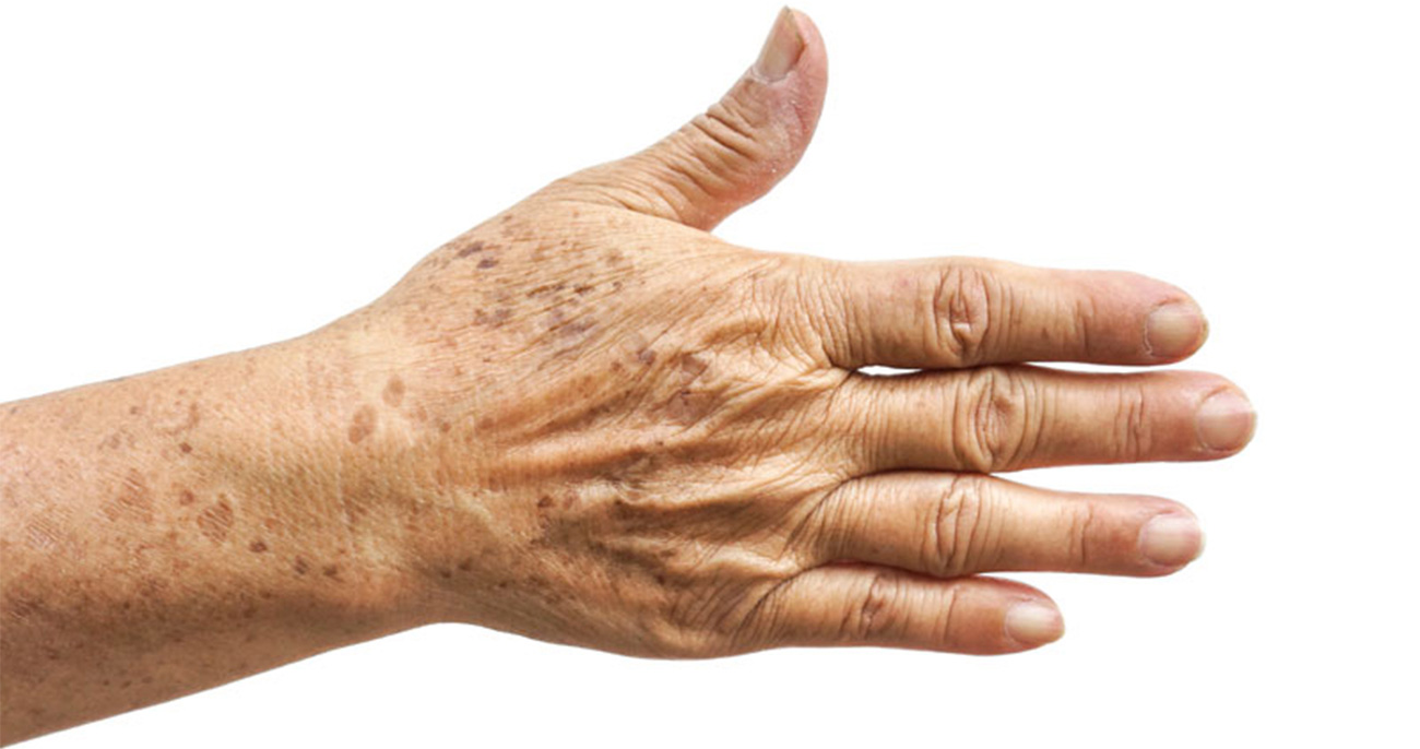Hand Rejuvenation