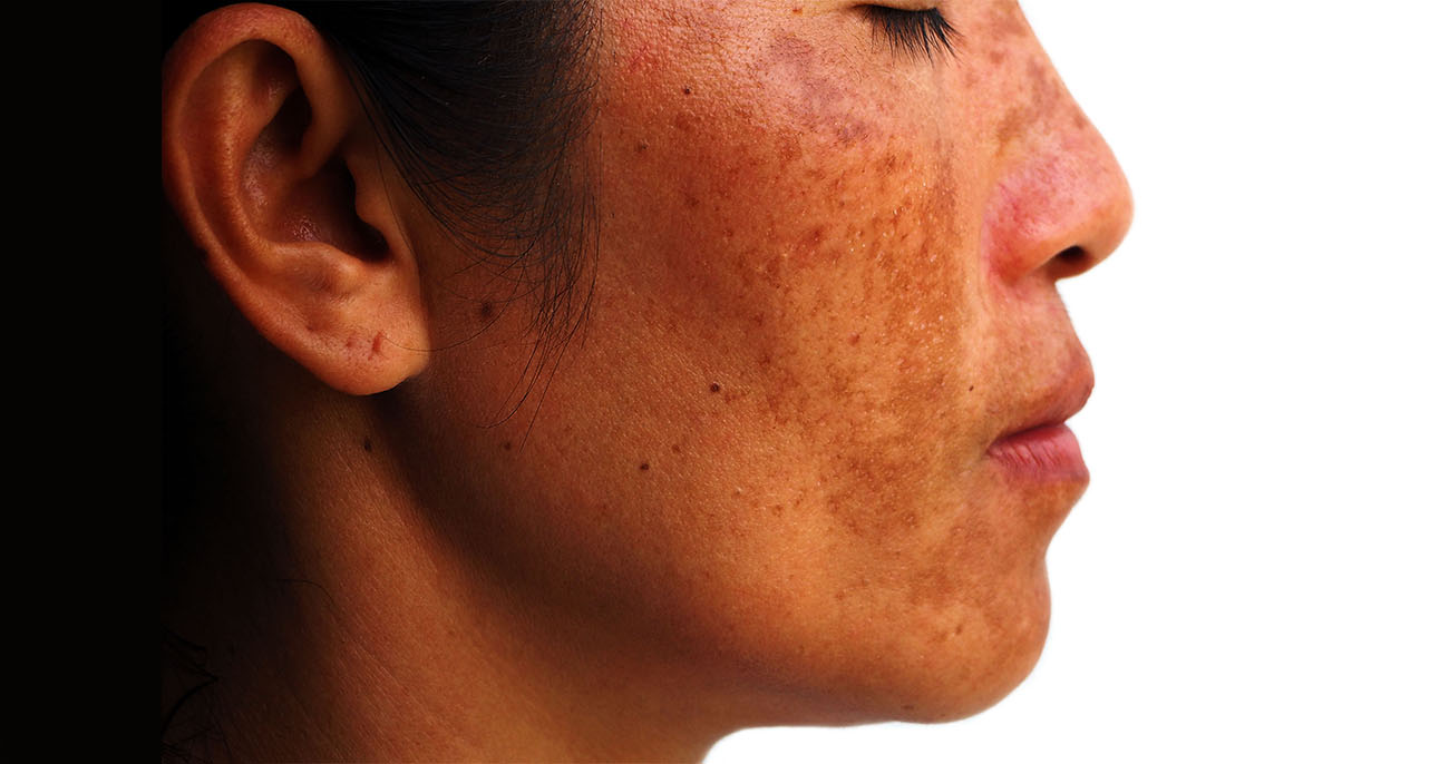 Melasma Treatment