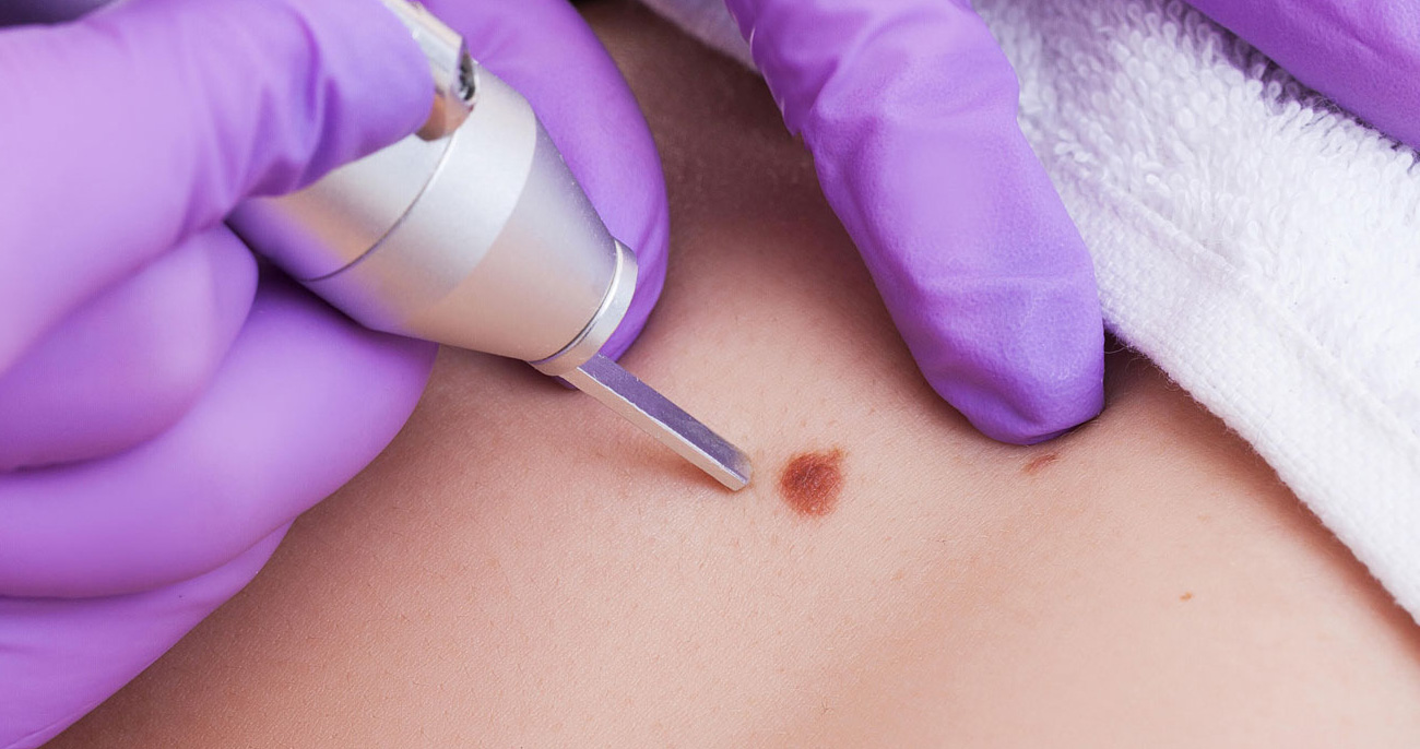 Moles, Milia & Skin Tags Removal Treatment