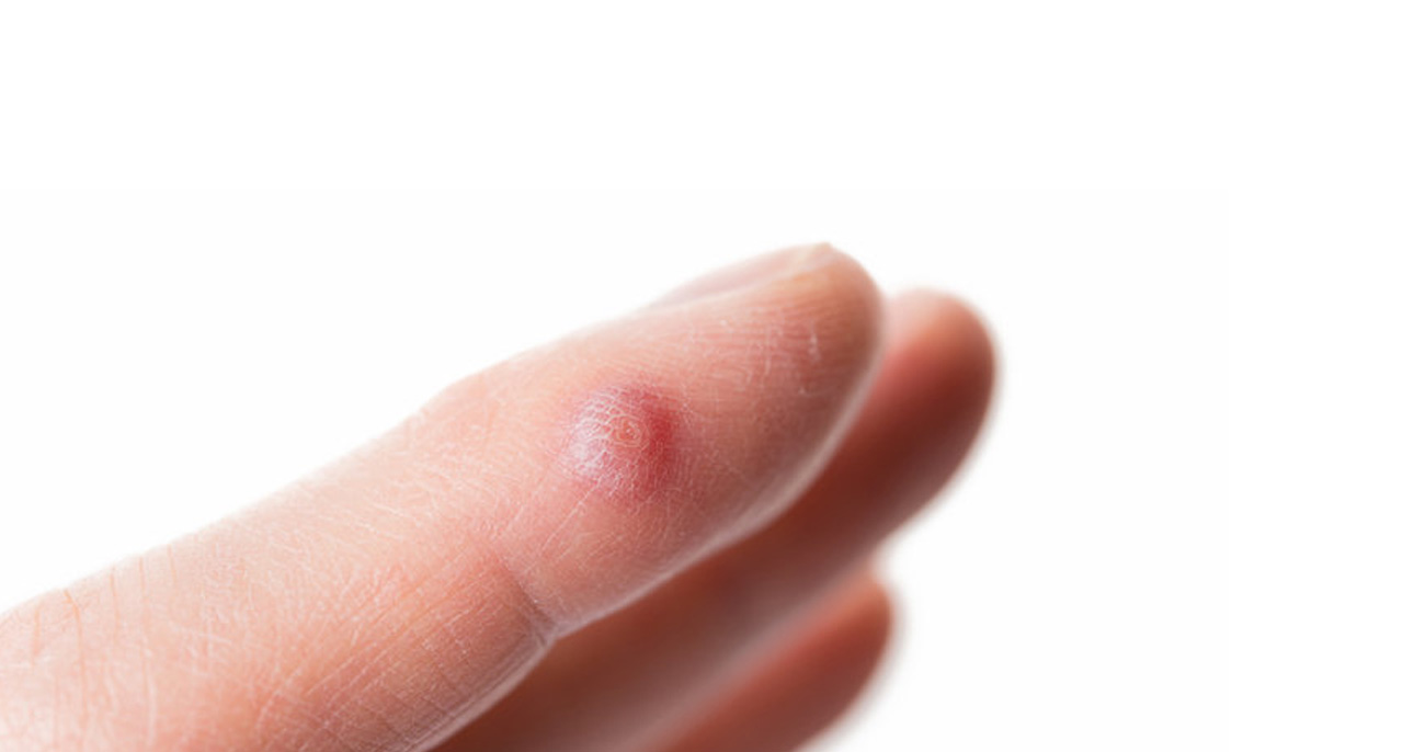 Warts Removal