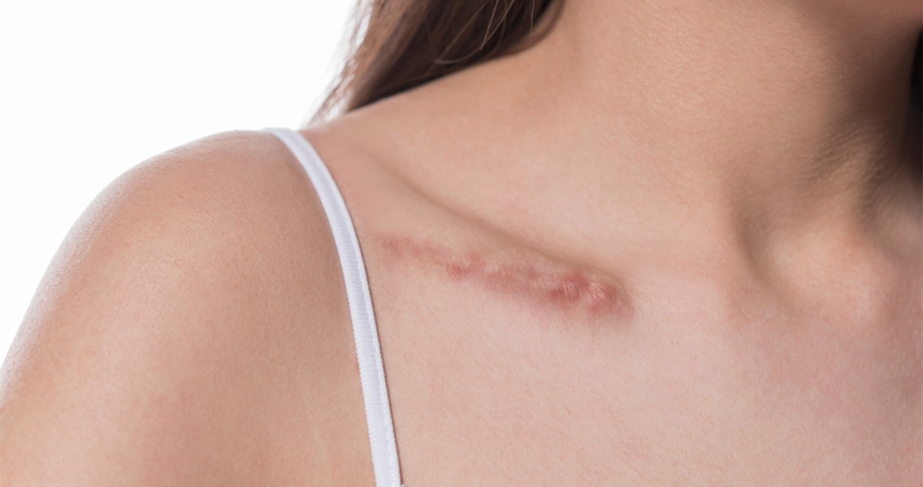 Scars Removal Treatment